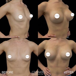 Image of Breast augmentation - Cronos Med