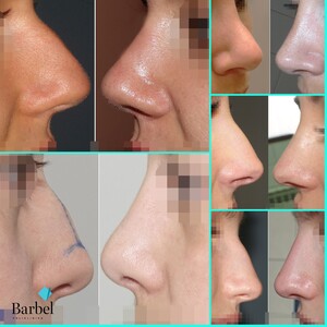 Image of Rhinoplasty - Barbel Polyclinic