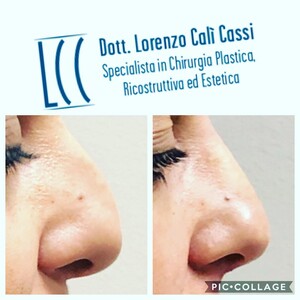 Image of Rhinoplasty - Dr Lorenzo Cali Cassi 