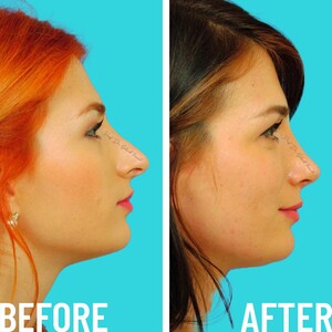 Image of Phoenix Healthy - Rhinoplasty