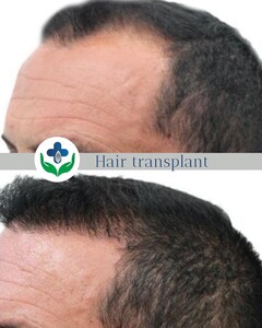 Image of Colombia Care Hair Transplant Gallery 3