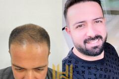 Image of MD.Adem Köse - Hair Transplant Turkey Gallery 2