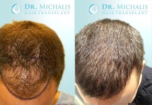 Image of Dr. Michalis Hair Transplant Gallery 1