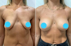 Image of Breast implants