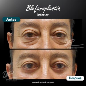 Image of Before and after eyelid surgery