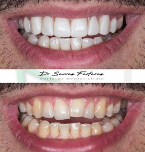 Image of Injectable veneers - Farfaras Dental Clinic