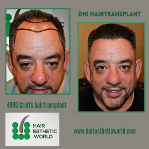 Image of DHI Hair Transplant