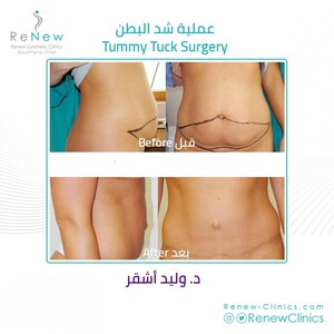 Image of Renew Clinics offers expert tummy tuck procedures for a toned abdomen.