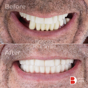 Image of Dental implants