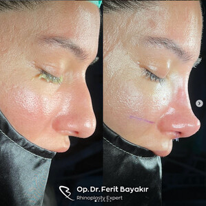 Image of Bursa Rhinoplasty - Op. Dr. Ferit Bayakır Gallery 2