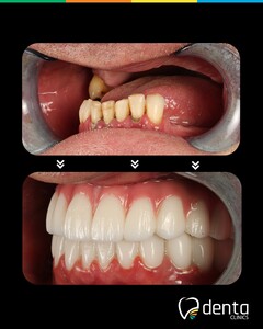 Image of dental implants