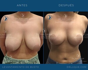 Image of Breast lift