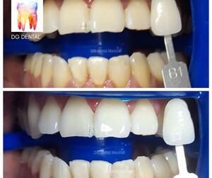 Image of Teeth whitening