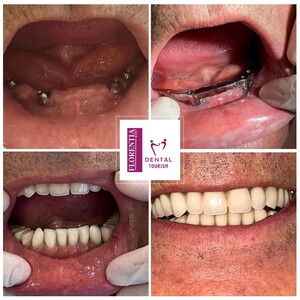 Image of Dental implants - Florentia Dent 