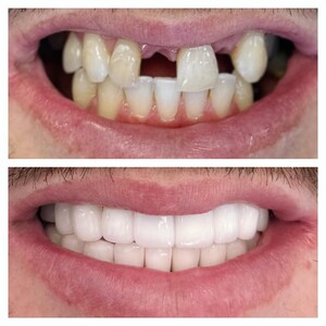 Image of Dental implants - Dent Medica Bodrum