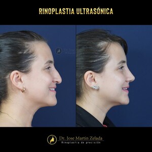 Image of Ultrasonic rhinoplasty