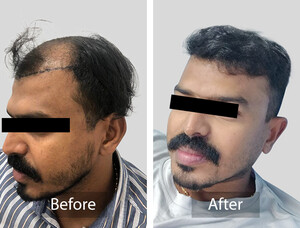 Image of Hair Transplantation Before and After