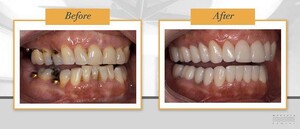 Image of Veneers