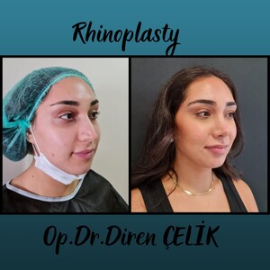 Image of Rhinoplasty