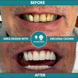 Image of Zirconia Crowns - Esteteeth Dental