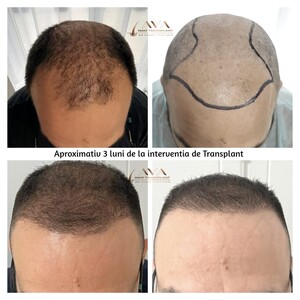 Image of FUE method transplant - Ava Hair Transplant