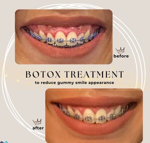 Image of Gummy Smile treatment