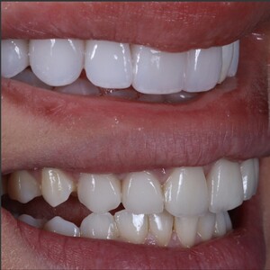 Image of Porcelain crowns