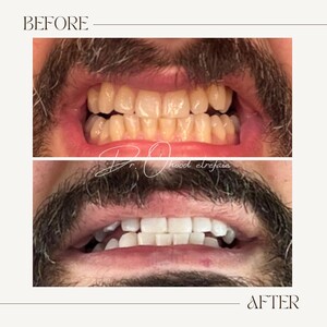 Image of Teeth Whitening - Dentalica Clinics