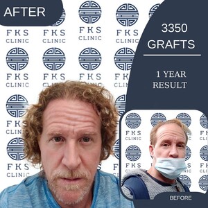 Image of 1 year after hair transplant