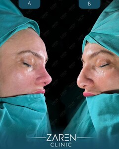 Image of Rhinoplasty