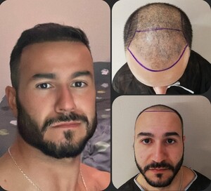 Image of Hair loss surgery - H2 Clinica