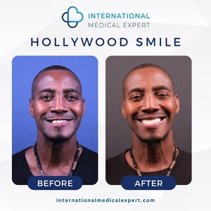 Image of Hollywood Smile before and after