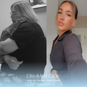 Image of Elite Med Clinic Before After Weigh Loss