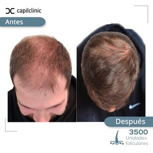 Image of Hair transplantation results