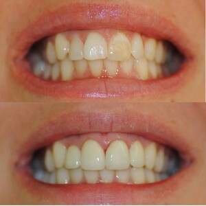 Image of Teeth Whitening - Stoma