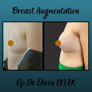 Image of Breast augmentation