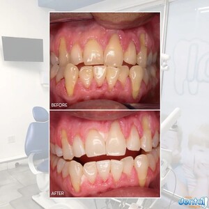 Image of Teeth whitening