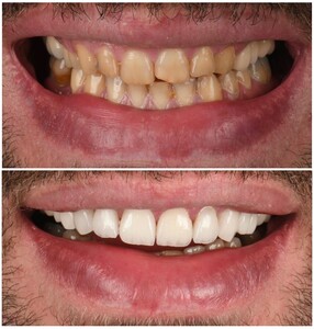 Image of Porcelain veneers - Dentalica Clinics