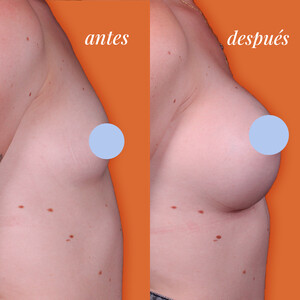 Image of Breast Implant