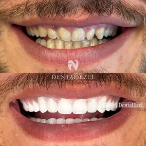 Image of Dental treatments before and after