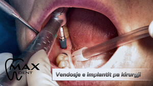 Image of Dental implant placement procedure 