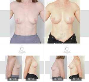 Image of Breast Implants - Clinicus