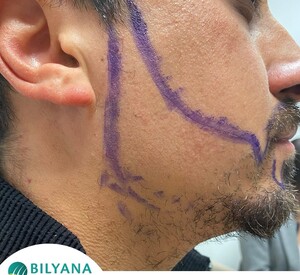 Image of Beard Transplant