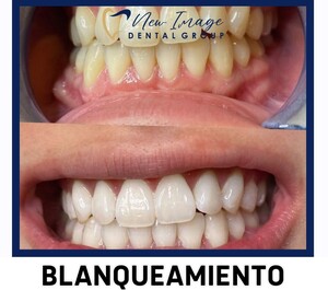 Image of Whitening