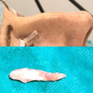 Image of Nose job - Dr. Kümpel Chirurgia Ästhetica