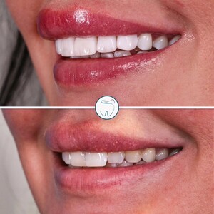 Image of Teeth whitening