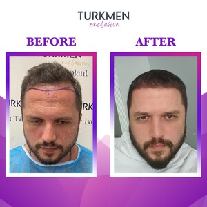 Image of Turkmen Hair Transplant Gallery 1