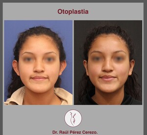 Image of Otoplasty