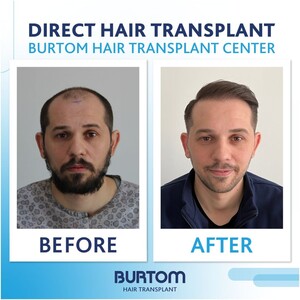 Image of Burtom Hair Transplant Center Gallery 2