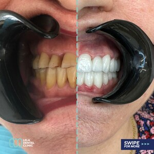 Image of Hollywood Smile - Lela Dental Clinic